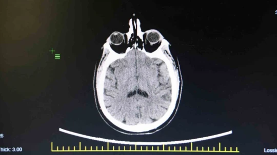 KBB Uzmanı Prof. Dr. Sakallıoğlu: 'İşitme kaybının çok büyük bir kısmı tedavi edilebilmektedir'